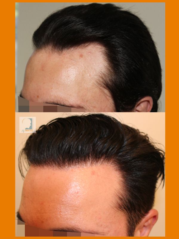 http://i1347.photobucket.com/albums/p701/worldhairtransplantcenter/Class%203/dry%20left_zpstjpzlfb8.jpg