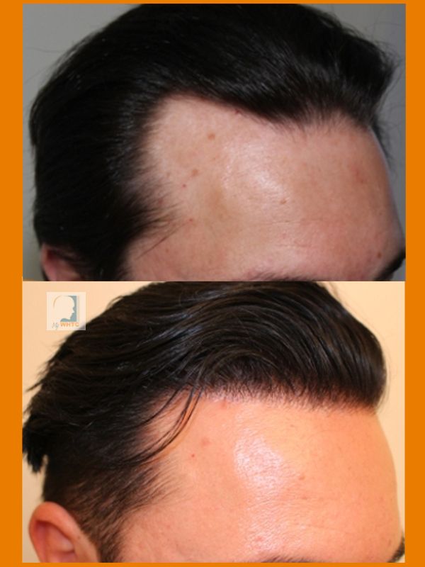 http://i1347.photobucket.com/albums/p701/worldhairtransplantcenter/Class%203/dry%20right_zpskmm6tqjt.jpg