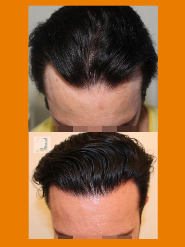 http://i1347.photobucket.com/albums/p701/worldhairtransplantcenter/Class%203/fdd_zpsb5d2xu9n.jpg