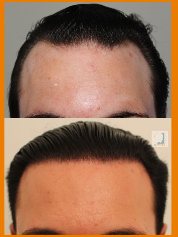 http://i1347.photobucket.com/albums/p701/worldhairtransplantcenter/Class%203/front%20c%20wet_zps7vmkmzvy.jpg