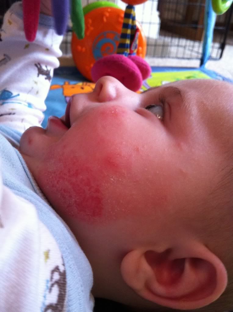 Weeping and infected eczema BabyCentre